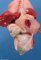 Anorectal agenesis with rectovesical fistula
