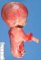 Caudal dysplasia and lower limb agenesis in maternal diabetes (Case (...)