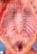 Caudal regression syndrome with lumbosacral agenesis and situs (...)