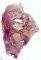 Progressive chronic pulmonary aspergillosis in cystic fibrosis