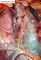Hemopericardium