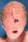 Holoprosencephaly: cyclopia, proboscis, nasal agenesis