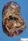 Intrapulmonary bronchogenic cyst