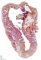 Ovarian mature cystic teratoma