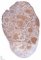 CD20+ nodules in progreesive transformation of germinal centers (...)