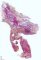 Anorectal agenesis with rectourethral fistula