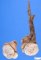 Chondroid teratoma component of a mixed germ cell tumor (yolk sac (...)