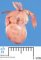 Tricuspid atresia