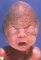 Turribrachycephaly in Pfeiffer syndrome
