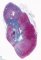 Polar superior chronic interstitial nephritis in a severe vesico-ureteral (...)