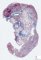 Pulmonary arteriovenous malformation