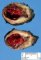 Thrombosed lymphangioma