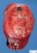 Focal nodular hyperplasia