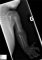 First metacarpal severe hypoplasia