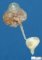 Renal adysplasia (case 11385)