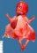 Megacystis sequence by urethral obstruction (17 weeks) (Case (...)
