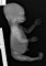 Sirenomelia dipus (Case 12623)
