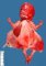 Fetus, 17 weeks. Urethral atresia and megacystis sequence