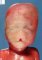 Hypotelorism, nasal aplasia, medial cleft in alobar holoprosencephaly (Case (...)