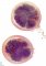 Appendiceal lymphoid hyperplasia