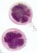 Appendiceal lymphoid hyperplasia