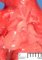 Tetralogy of Fallot (fetus, 16 weeks)