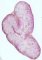 Feta adrenal clarification in hydrops fetalis (25 weeks)