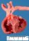 Pulmonary artery hypoplasia