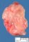 Invasive pulmonary aspergillosis