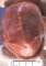 Premature fusion of sagittal scranial suture in Pfeiffer syndrome (sagittal (...)