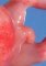 Genital bud in a girl with urethral atresia and imperforate (...)