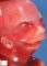 Severe mandibular hypoplasia in acrorenal-mandibular syndrome