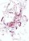 Lymphatic-predominant combined vascular malformation