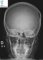 Cranial eosinophilic granuloma