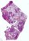 Bronchiectasis in cystic fibrosis and peribronchial inflammation in cystic (...)