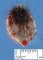 Nodular melanoma of the scalp