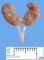 Horseshoe kidney