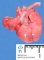 Bilateral pulmonary hypoplasia in oligohydramnios sequence