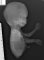 Caudal dysplasia and lower limb agenesis in maternal diabetes (Case (...)