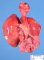 Right aortic arch in situs anomaly (Fetus, 24 weeks)