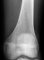 Fibrous cortical defect (eMedicine)