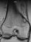 Fibrous cortical defect (eMedicine)