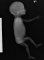 Humeral meromelia (fetus, 21 weeks)