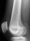 Fibrous cortical defect (eMedicine)