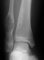 Multiple fibrous cortical defects