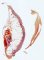 Ovarian mature teratoma