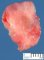 Invasive pulmonary aspergillosis
