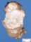 Chondroid teratoma component of a mixed germ cell tumor (yolk sac (...)