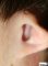Microtia