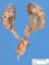 Renal pelvic dilatation